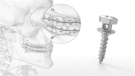 Titanium Dental Mini Implant Omi™ Acumed Screw Orthodontic