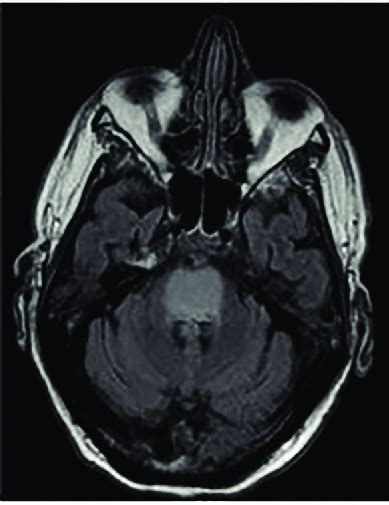 Mri Imaging Demonstrating Central Pontine Myelinolysis A The Axial