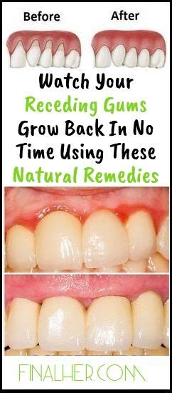 Grow Back Your Receding Gums With These Natural Remedies Beautiful