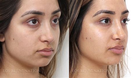 Cheek Augmentation Before And After Beverly Hills Dr Nima