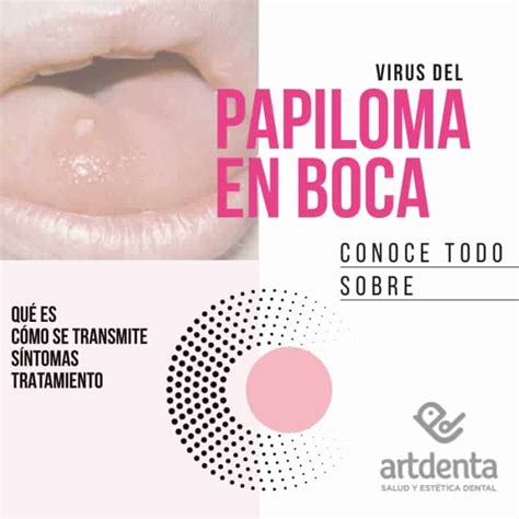 Virus Del Papiloma En Boca Qu Es Tratamiento Cl Nica Dental En Valencia Benimaclet