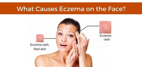 Eczema On The Face Possible Causes And Natural Treatments