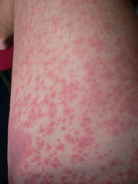 Allergie Auf Amoxicillin Beim Menschen In Form Von Hautausschlag