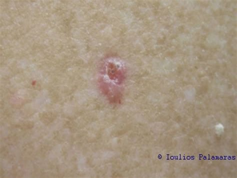 Cancer Lesions On Skin