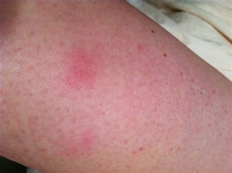 Tiny Pinpoint Red Dots On Skin Not Itchy Tyredthree