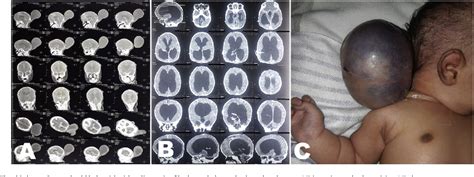 Figure 3 From Shunt Exposure As A Ventriculoperitoneal Shunt Complication A Case Series