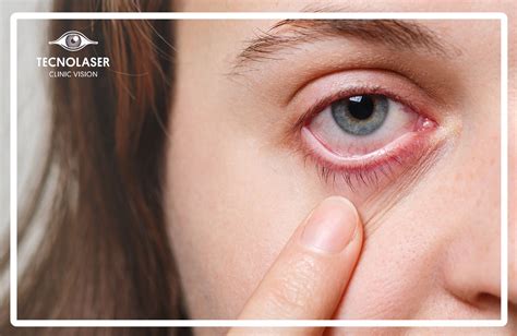 Rosácea Ocular Síntomas Y Tratamiento Tecnolaser Clinic Vision