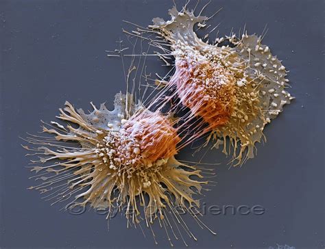 Skin Cancer Cells Under Microscope