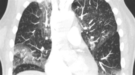 Short And Long Term Effects Of Covid 19 On The Lungs