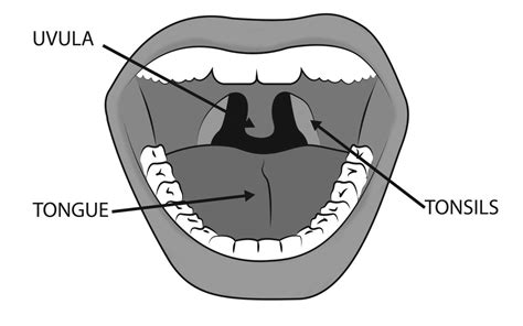 Swollen Uvula Causes Symptoms Treatment And Remedies Hubpages