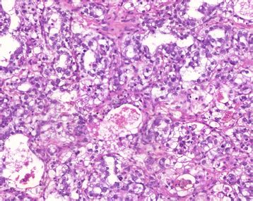 Yolk Sac Tumor With A Reticular Pattern Formed By A Loose Meshwork Of