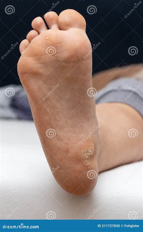 Plantar Wart On The Bottom Of A Female Foot Heel Caused By The Human