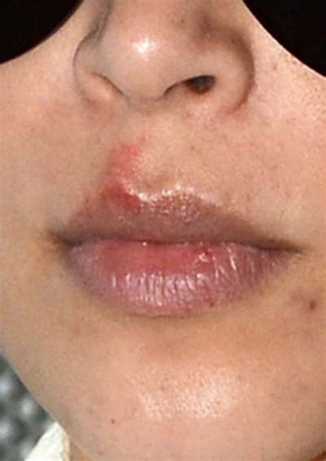 Kim Kardashians Face Herpes Face Of The Day