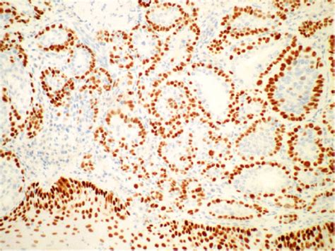 P63 Immunohistochemistry Stain Of Epithelial Myoepithelial Carcinoma In