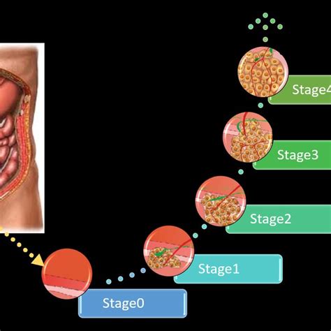 The Different Stages Of Colon Cancer Download Scientific Diagram