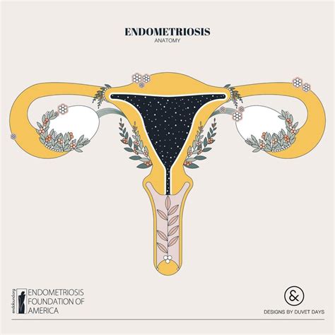 Harald krentel, generalsekretär der europäischen endometriose liga e.v. Wat is Endometriose? - Naomi Kramer