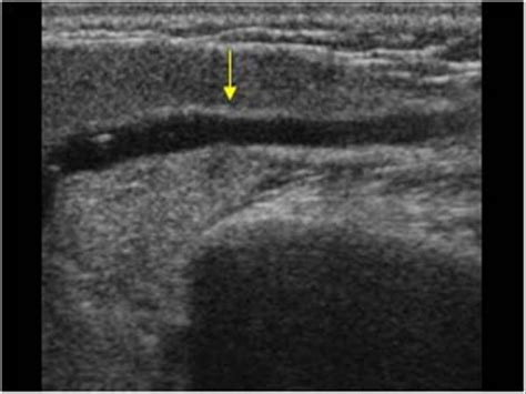 Parotid Duct Stone Ultrasound