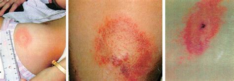 Jun 02, 2021 · souvent porteuse de la bactérie borrelia burgdorferi, responsable de la maladie de lyme, elle est étroitement surveillée par l'institut national de santé publique du québec. Stade 1 - tiquatac.org : Maladie de Lyme et les tiques