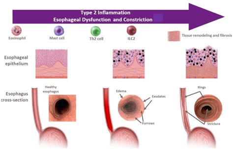 Current State Of Biologics In Treating Eosinophilic Esophagitis