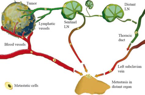 Tumor And Lymph Node Lymphangiogenesis—impact On Cancer Metastasis