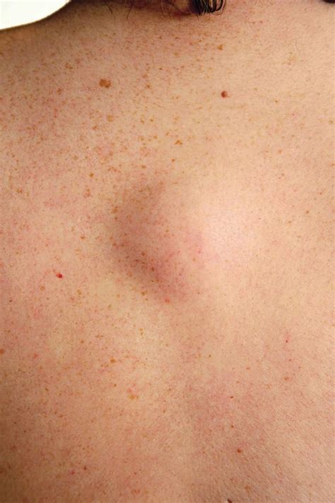 If You See One Of These 13 Bumps On Your Skin Do Not Pop