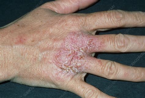 Close Up Of Eczema On Hand Knuckles Stock Image M1500124