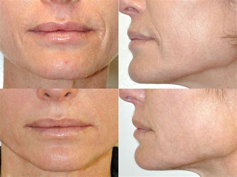 New Procedure Dubbed Inside Out Face Lift Claims To Smooth Skin Abc