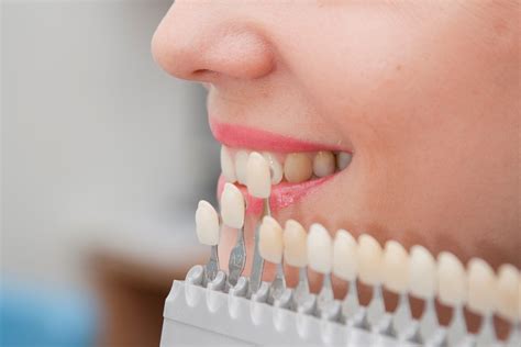 Estética Dental y Diseño de Sonrisa Carillas y Aclaramiento Dental