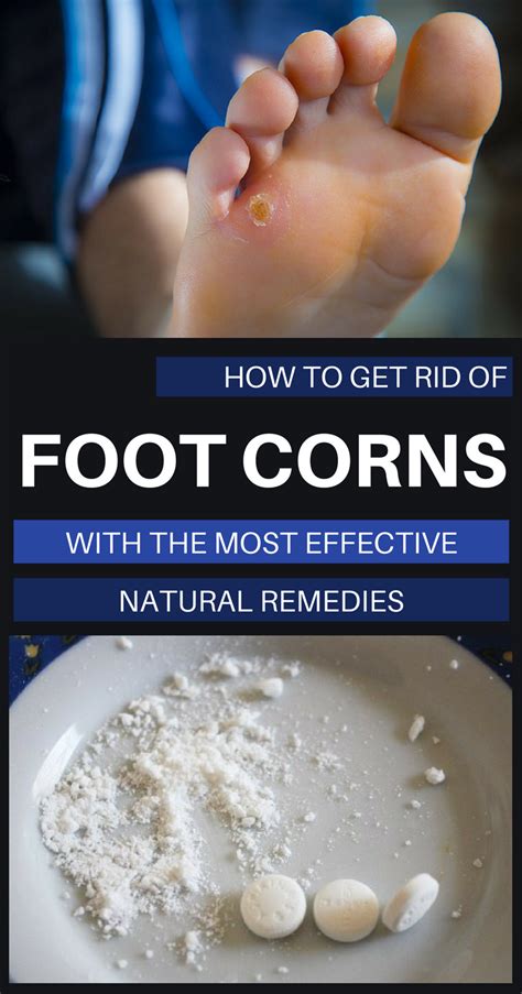 How To Get Rid Of Foot Corns With The Most Effective Natural Remedies