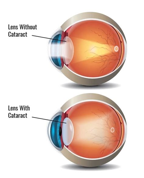 cataract surgery springfield missouri eye institute branson