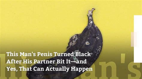 This Man S Penis Turned Black After His Partner Bit It—and Yes That Can Actually Happen Video
