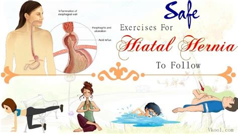 16 Safe Exercises For Hiatal Hernia To Follow