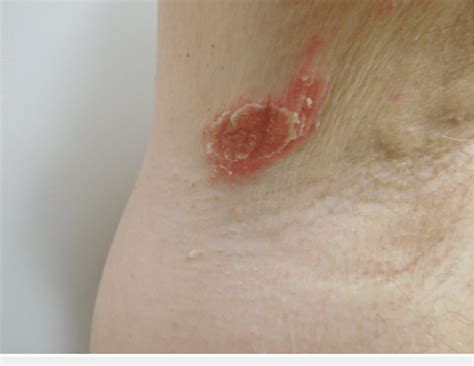 Psoriasiform Dermatitis Closer View Of The Scaly Red Plaques In The
