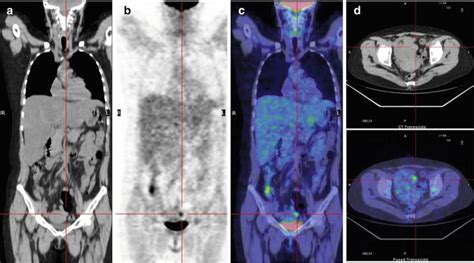 18f Fdgpetct In Pediatric Lymphoma Radiology Key