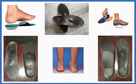 Prosthetics And Orthotics From My Care Custom Made Insoles For Flat Feet Pes Planus
