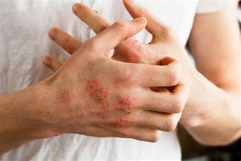 What Is Atopic Dermatitis And Its Causes Foknewschannel
