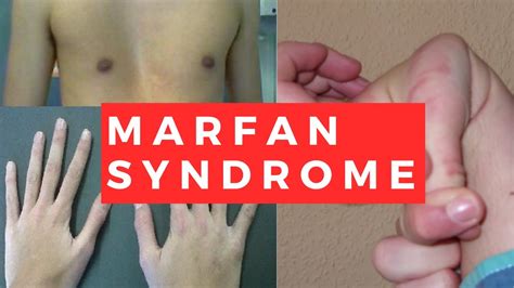 Marfan Syndrome Pathology Clinical Presentation Diagnosis And Treatment Youtube