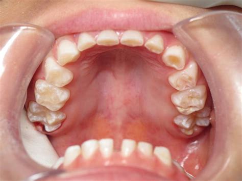 Why was teeth grinding such a common complaint that, to me at least, popped up more and more in, say, the past 835 days, 9 hours, 29 minutes, and for starters, the clinical name for excessive teeth grinding or jaw clenching is called bruxism. Sleep herb mhfu, grinding of teeth in babies, why do we ...