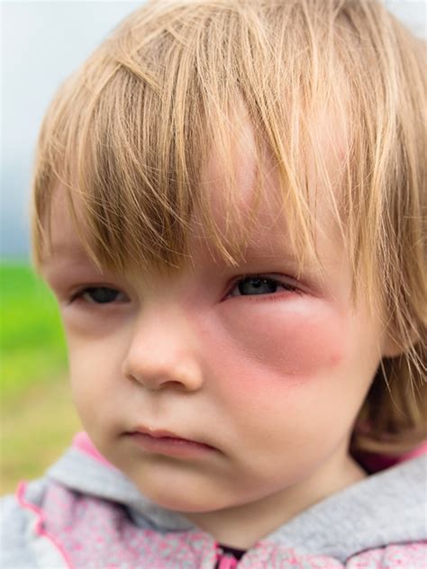 Anaphylaxis Pediatric Signs And Symptoms Mims Malaysia