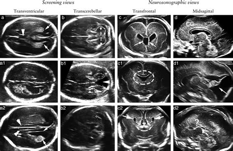 Indications For Mri In Fetal Isolated Mild Ventriculomegaly ‘and Then