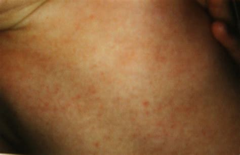 Identifying Skin Rashes Pictures Photos