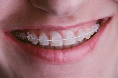 How you maintain your braces (broken brackets rebonding again and again increases duration of treatment). How Long Do You Have to Wear Braces? - Willow Creek ...