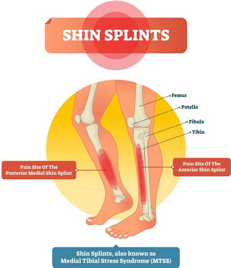 Va Disability Ratings For Shin Splints Explained Cck Law