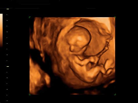 Pues a mi me dijieron que mi hija seria una mujercita a los 15.5 semanas de gestacion y si tengo una hermosa niña de 5 meses! Ecografía 3D de la 15 semanas: Así es el feto
