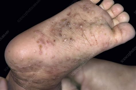 Scabies Infection On The Skin Stock Image C053 1975 Science Photo