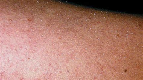 Keratosis Pilaris Diet Why It Doesnt Work Plus Proven Remedies
