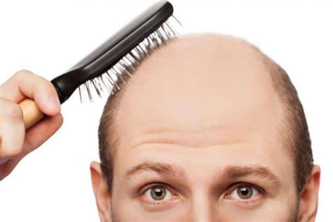 Receding Hairline Signs And Treatment Hairstylecamp
