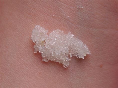 Small Round Patch Of Dry Skin On Arm Interpureqaover