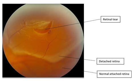 Retinal Tear Retinal Detachment Recognizing Pathology Optos A