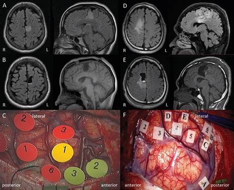Pdf Intraoperative Motor Symptoms During Brain Tumor Resection In The